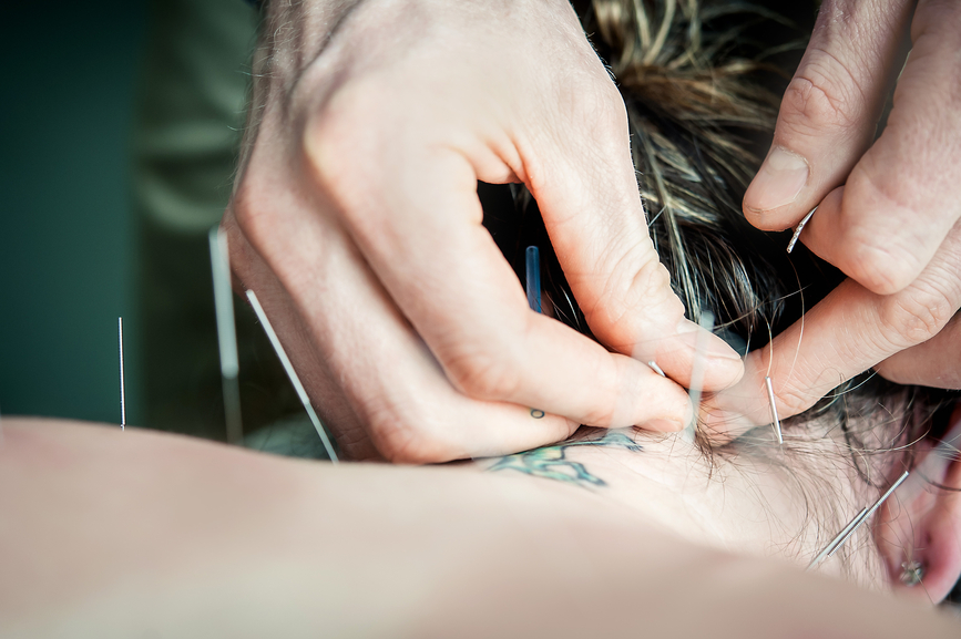 6 Ways Acupuncture Relieves Pain